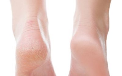 What to Buy: Footlogix Cracked Heel Formula or Rough Skin Formula?