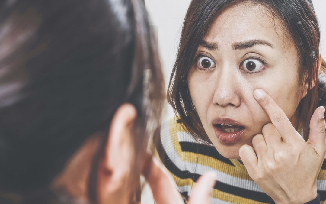 You Can Blame Hormones and Stress for Your Adult Acne