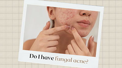 What is Fungal Acne and How Do I Know If I Have It?