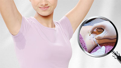 Sweat Is Out—Neurotoxins Are In: The Rise of Preventive Sweatox